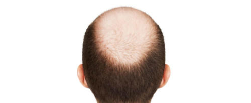 Hair_Restoration