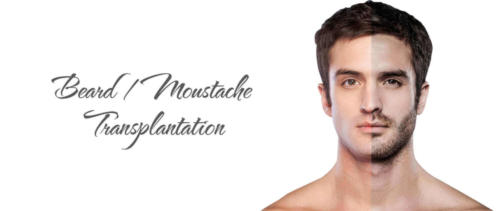 beard-mustache-hair-transplant