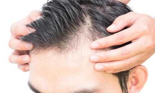 close-up-of-balding-man-s-hair