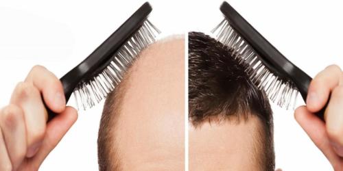 hair transplant pune