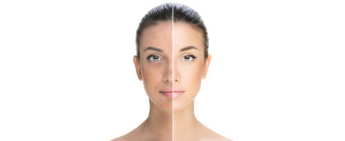 laser-resurfacing